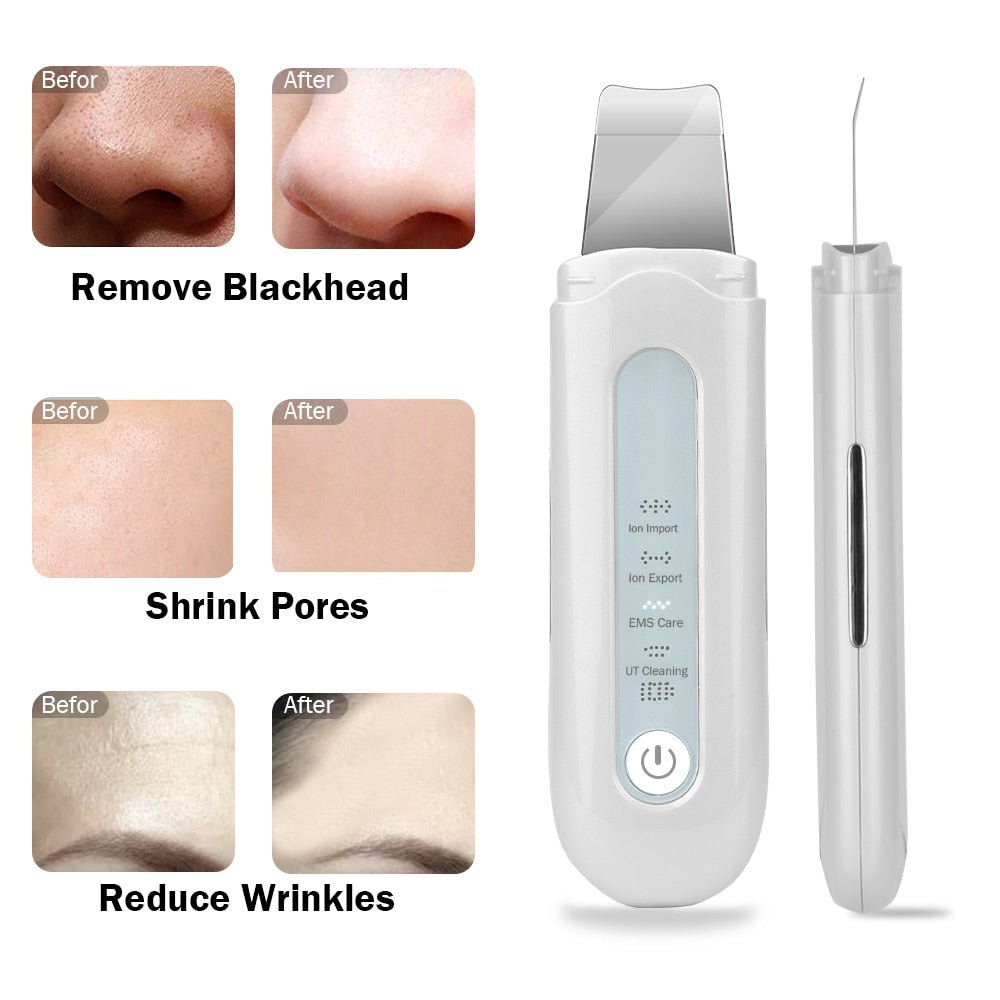 Blackhead Removal Skin Scrubber Ion Vibration Acne Exfoliating Peeling Spatula Ultrasonic Deep Face Cleaning  Pore Cleaner Tool-3